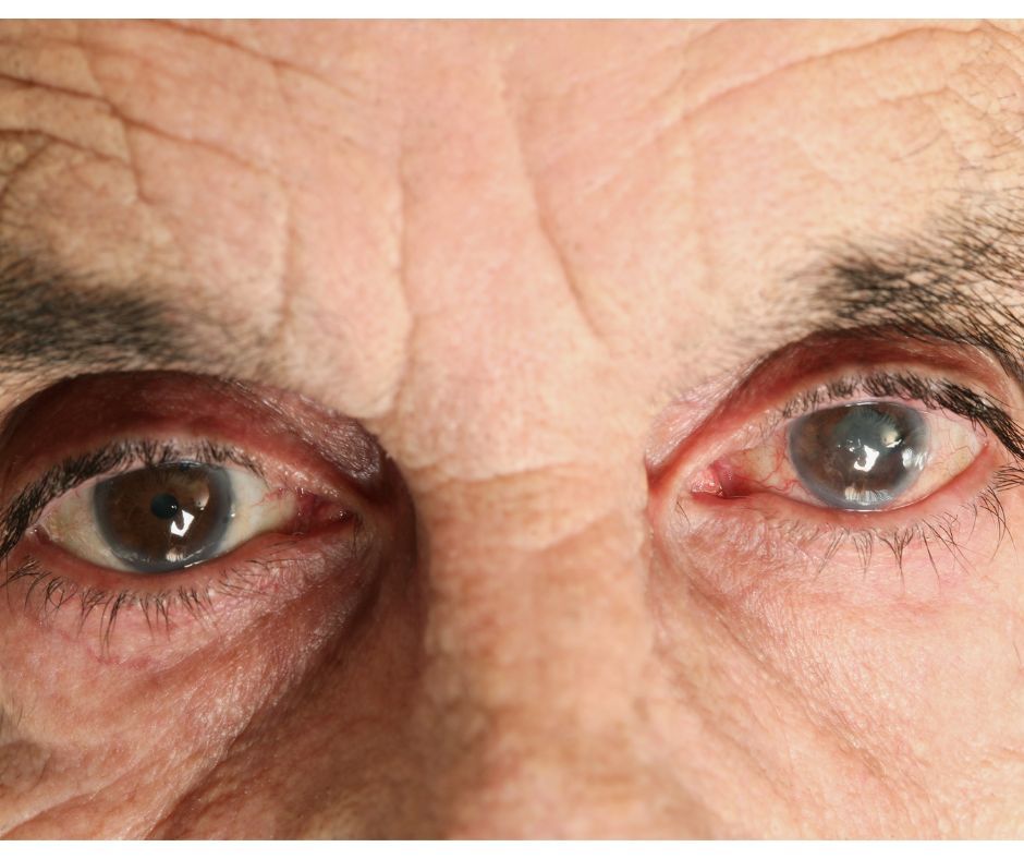 Regard ciel homme atteint d'un glaucome